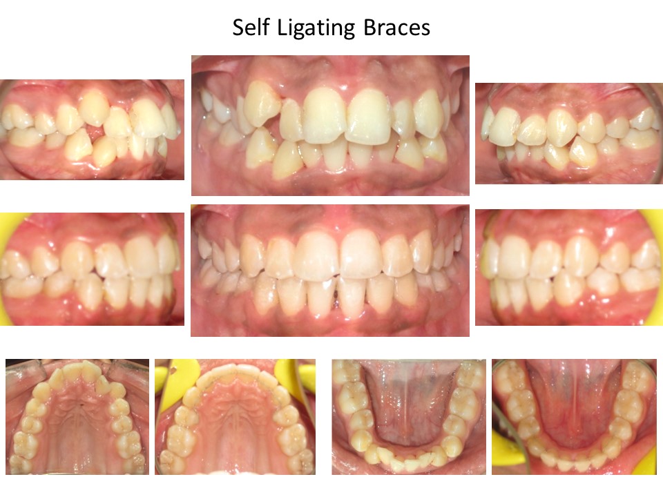 Self Ligating Braces