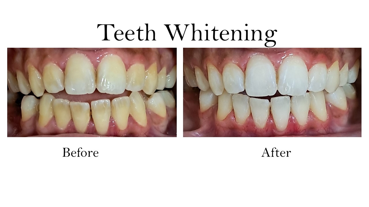 Teeth Whitening